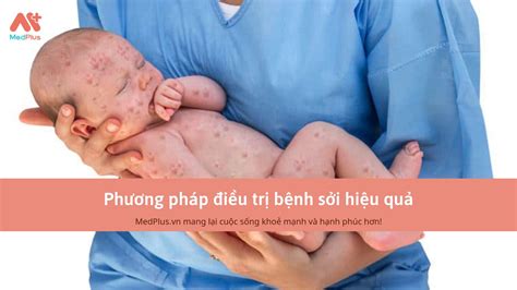 Phương pháp điều trị bệnh sởi hiệu quả - Medplus.vn