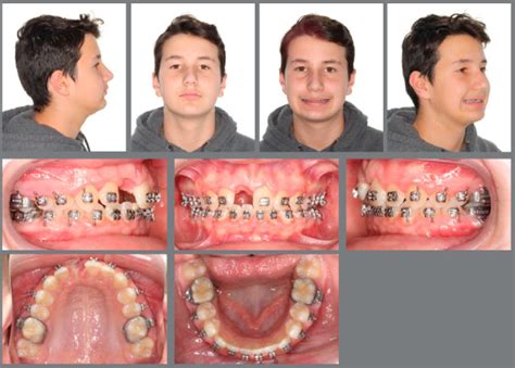 management  ankylosed teeth   decoronation technique