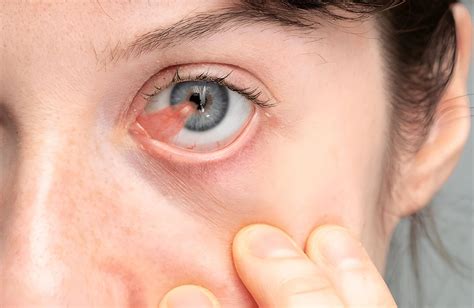 pterygium surfers eye