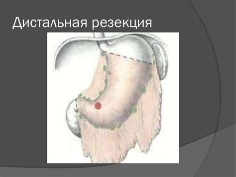 Рак желудка - презентация онлайн