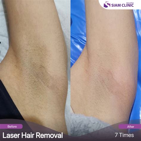laser hair removal before and after 1