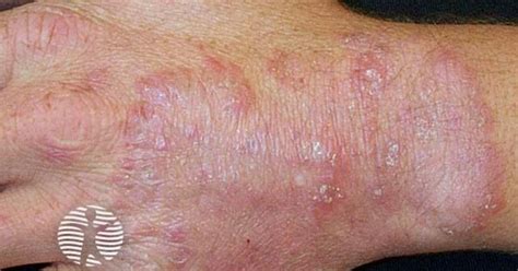 tinea manuum image
