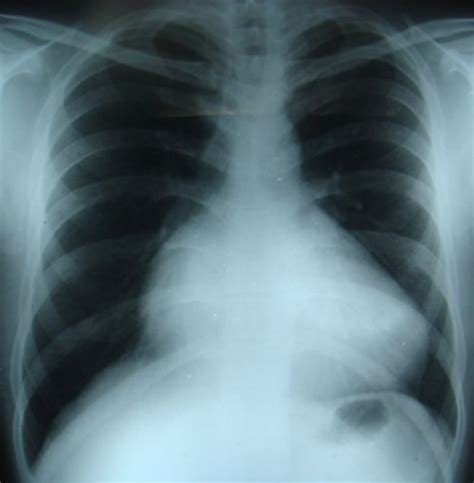 Ebstein's anomaly of tricuspid valve