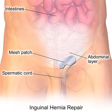 Top Doctor Offering Groin Hernia Repair