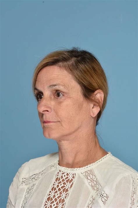 mid face lift before & after 6