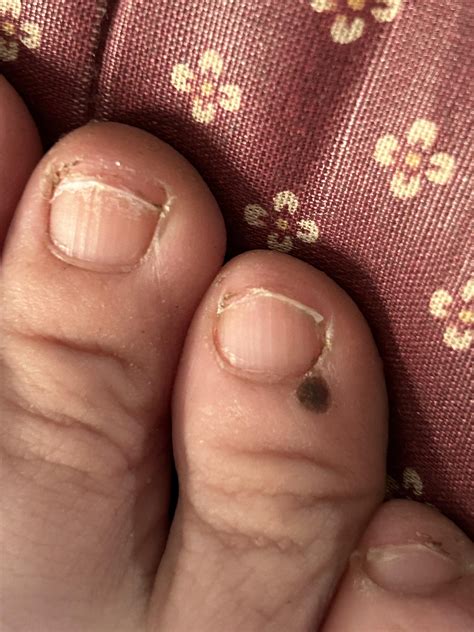 Is this just a mole or freckle? : r/Melanoma