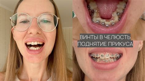 Я ПОСТАВИЛА БРЕКЕТЫ! | об этом нужно знать, если хотите их ставить ...