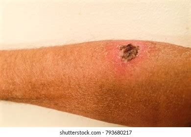 imagens de black lesion scab imagens fotos stock  vetores