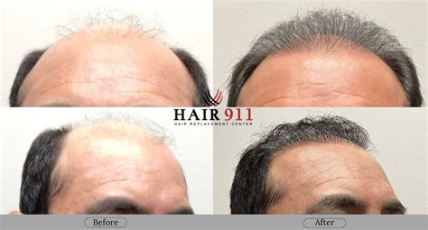 hair transplant   fue results  riverside ca hair