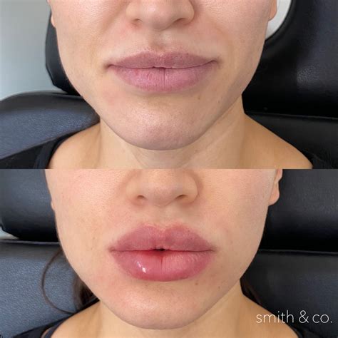 38 𝐋𝐢𝐩 𝐟𝐢𝐥𝐥𝐞𝐫𝐬 and lip fillers ideas to save today | lips inspiration