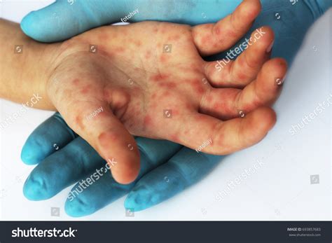 2,810 Foot rash Stock Photos, Images & Photography | Shutterstock