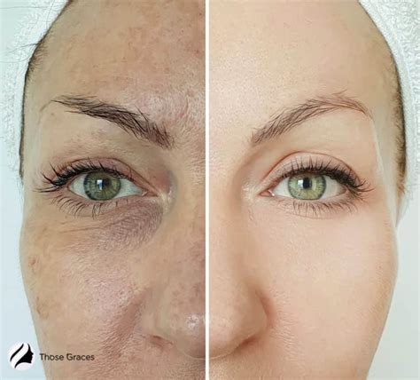 Albums 94+ Pictures Before And After Pictures Of Microdermabrasion Sharp