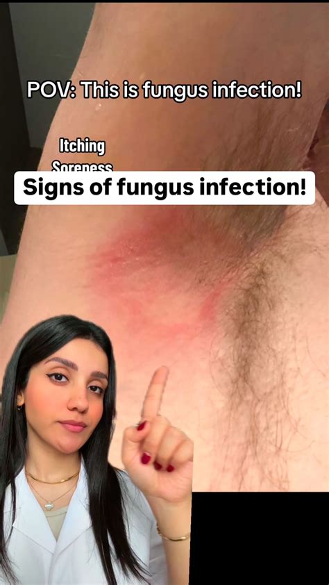 Dr. Farzan | These infections usually appear as a scaly rash or as