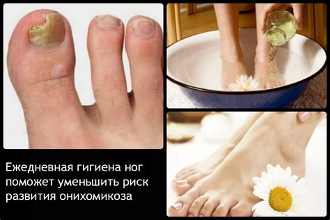 Грибок ногтя на большом пальце ноги: лечение, фото, отзывы