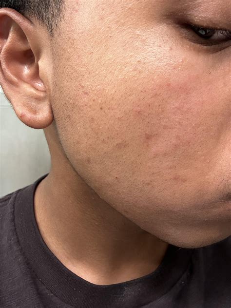 these weird rashes starting showing up on my face. is it acne? : r/acne