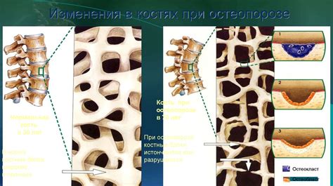 Остеопороз. Профилактика остеопороза - презентация онлайн
