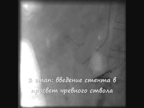 Стентирование чревного ствола - YouTube