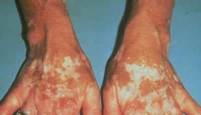 Liver Disease Spots On Skin