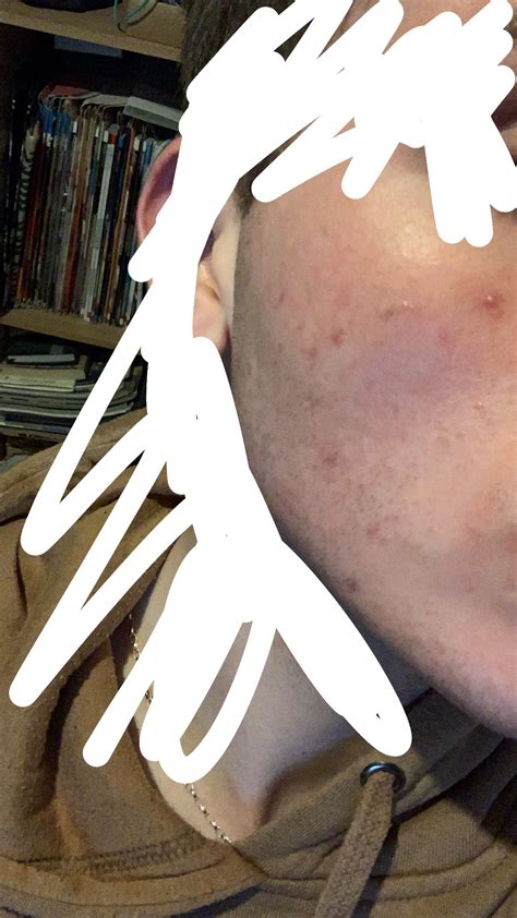Can antibiotics cure acne permanently? + Need help – Prescription acne