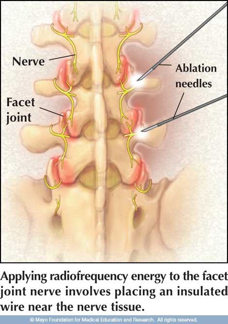 Radiofrequency Ablation - Pomona Pain Management Doctor | epidural ...