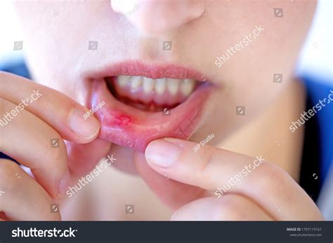 254 Cold Sore Canker Sore Images, Stock Photos & Vectors | Shutterstock