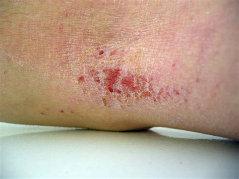 View 29 Pictures Of Skin Rashes Kids - involvetvpics