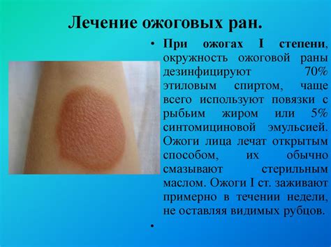 Ожоги. Термические ожоги. Химические ожоги. Электротравма. Лучевые ...