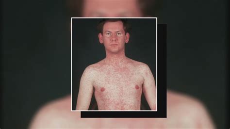 Measles patient visited third Fresno medical facility, health ...