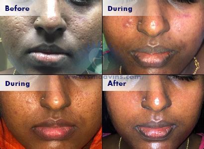 Best PRP-Skin Treatment - Click for more