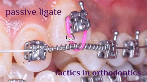 Passive ligate in orthodontics - YouTube
