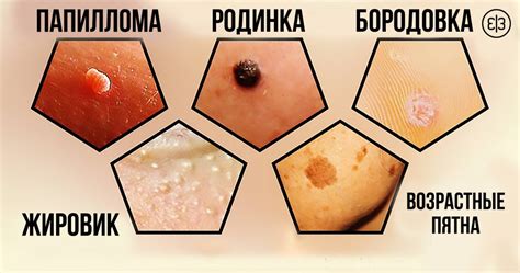 Как вывести бородавки под мышками