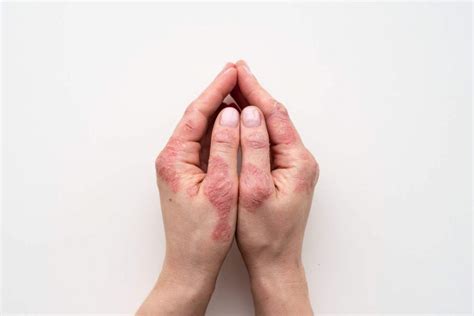 penularan penyakit kusta lifepackid