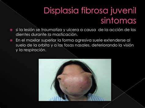 Displasia fibrosa