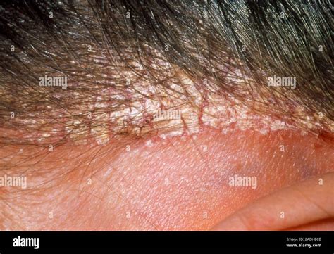 dandruff close  view   scalp    year  woman suffering