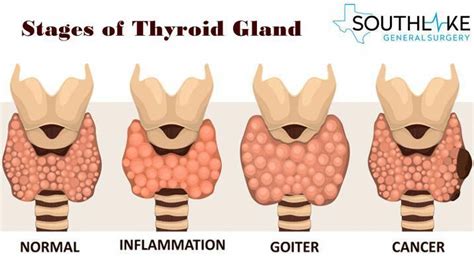 Thyroid cancer stages – Artofit