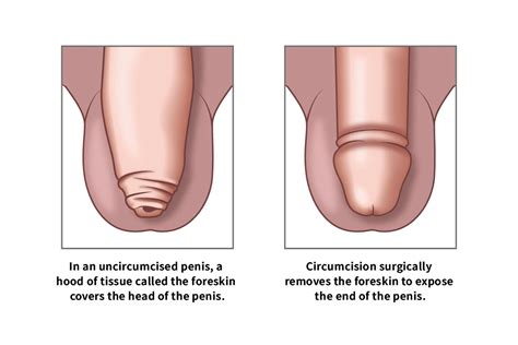 how to know if circumcision is infected