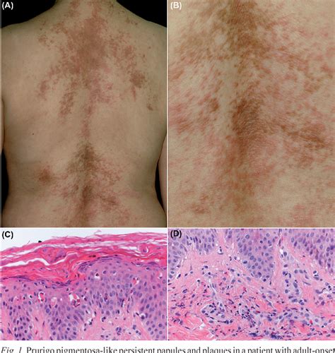 Still's Disease Radiology at Geraldine Givens blog