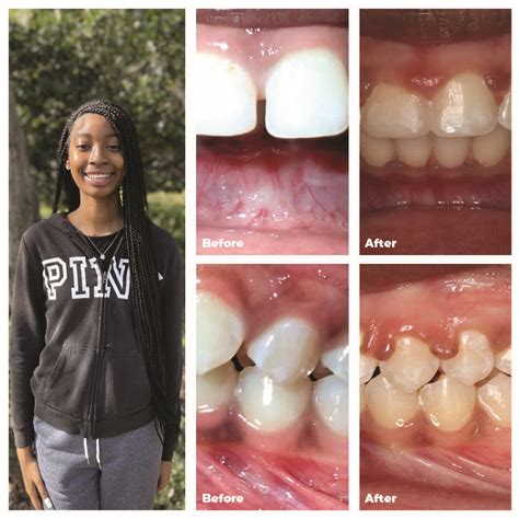 Get Clear Braces That Match The Color Of Your Teeth