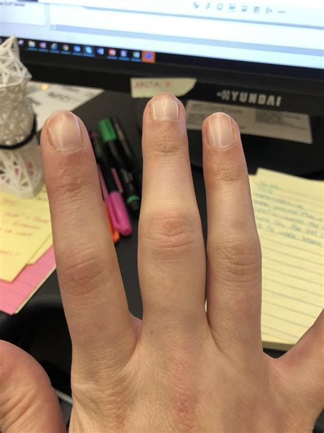 What Does It Mean When My Finger Joints Hurt at Cheryl Burgess blog