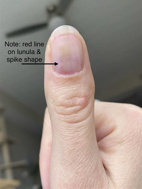 Habit Tic Deformity
