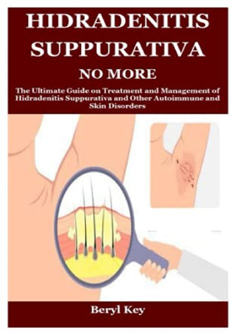 [READ PDF] HIDRADENITIS SUPPURATIVA NO MORE: The Ultimate Guide on