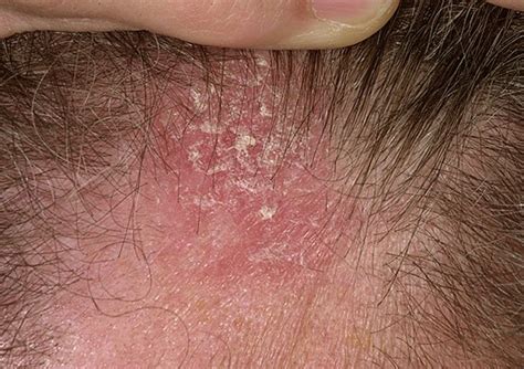 treatment  seborrheic dermatitis  related hair loss