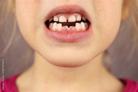 childs mouth   front teeth loss  baby teeth stock photo