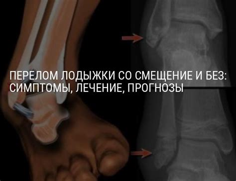 Перелом лодыжки со смешением и без, лечение, реабилитация, сколько ...
