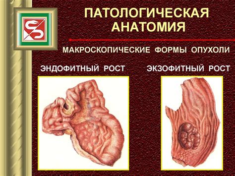 Рак желудка - презентация онлайн