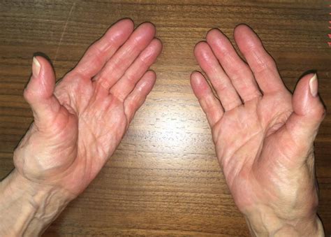 Thumb Arthritis - Causes, Symptoms, Exercises, Splint & Treatment