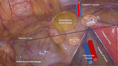 principles  laparoscopy  procedure  laparoscopic varicocelectomy