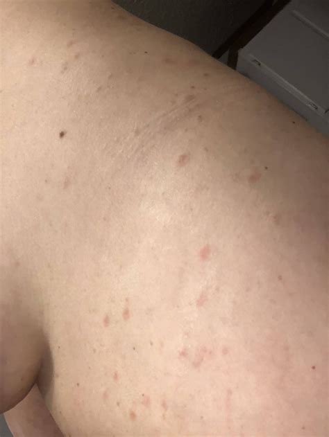 Pityriasis rosea – Artofit