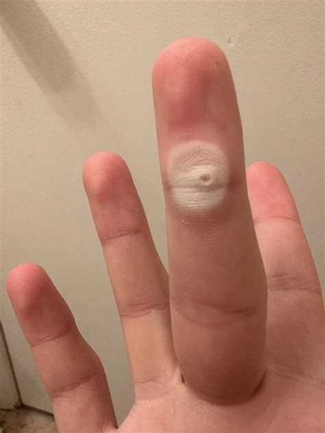 Using compound w band aid is this normal? : r/Warts