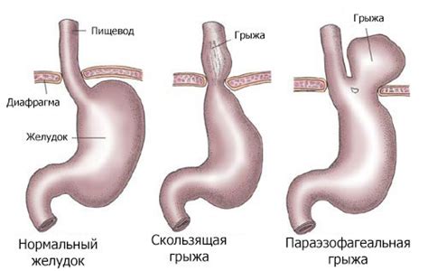 Грыжи: классификация, виды,симптомы, методы лечения